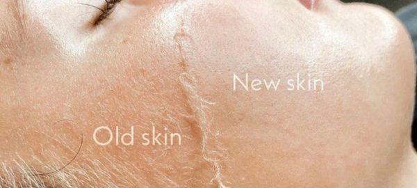 Dermaplaning removes vellus hair, allows better product absorption, and more.