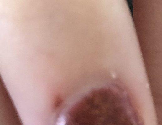 A cut that wouldn't stop bleeding.