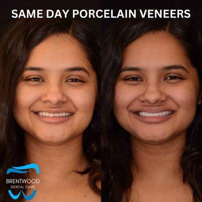 Veneers upgraded my smile