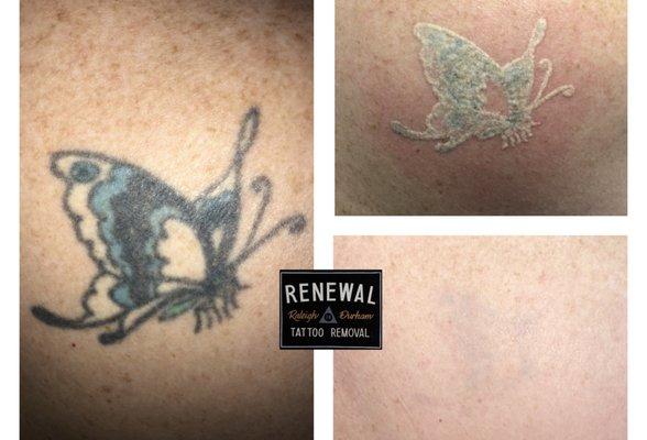 Renewal Tattoo Removal & Fading