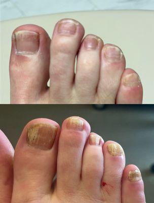 Before and after topical medication, 3 laser sessions, and temporary removal of the 4th and 5th toenails