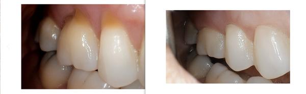 Pinhole Gum Lift Procedure