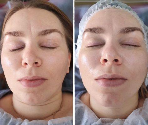 Hollywood Glow Facial -- instant radiance and smooth, refreshed skin after the treatment.