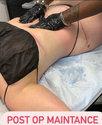 post operative Lymphatic massage Lipo and tummy tuck