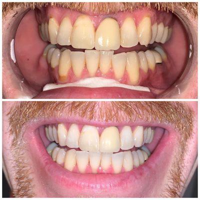 After 1 session. Mind you I'm a smoker!