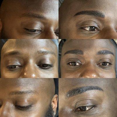 Combo Brow Procedure