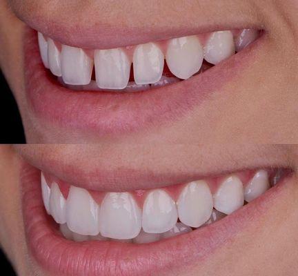 Porcelain veneers