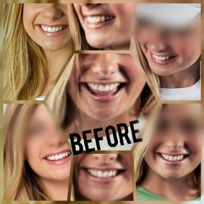 Smile Direct Club