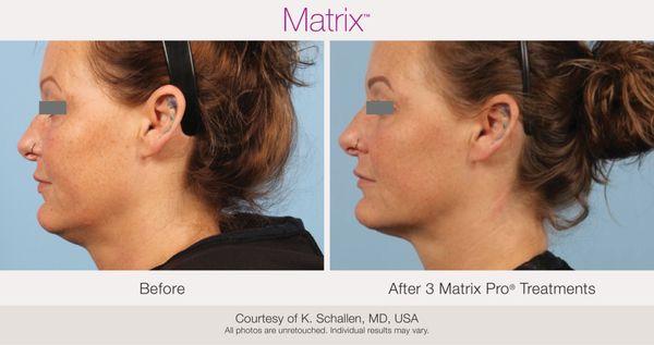 Matrix Pro Radiofrequency Microneedling for double chin