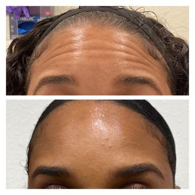 Forehead Tox with Botox