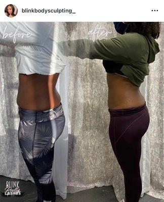 Body Contouring with Cavitation fat burning Machine