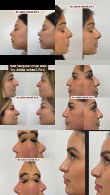Non-surgical nose job