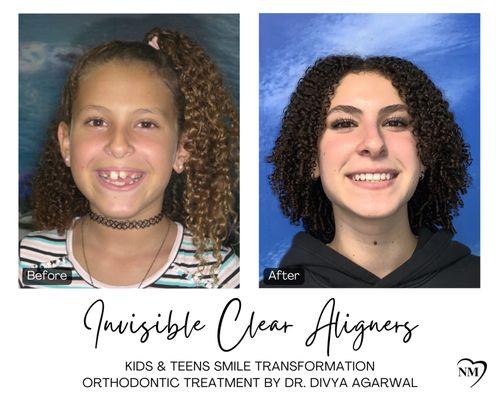 Watch how clear aligners straightened crooked teeth, giving a confident, happy smile kids and teens love!