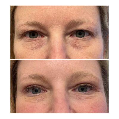 Before and after upper blepharoplasty and ptosis repair.