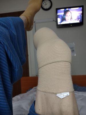 My leg after amputation