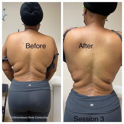 Fat Cavitation of the back. Notice rolls diminishing and waist getting smaller.
