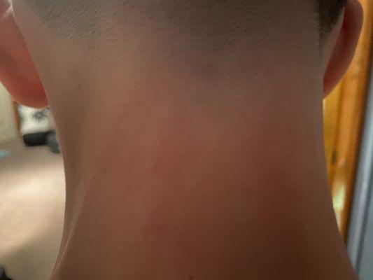 Back of neck several hours later..