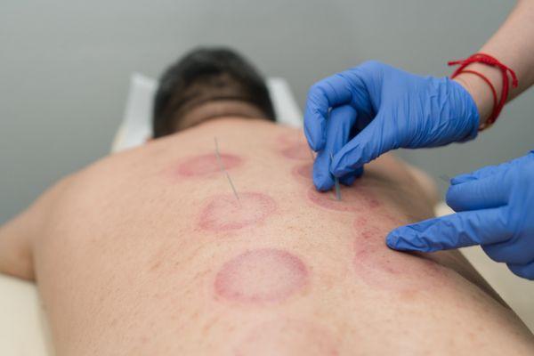 Cupping and stim needles