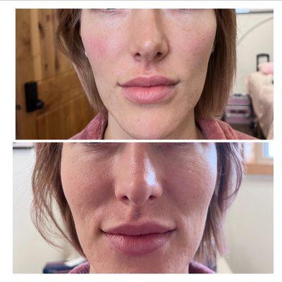 Before and After filler