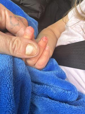My daughters missing finger nail.