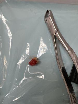 Extracted tooth