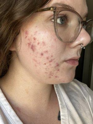 Before starting acne treatment