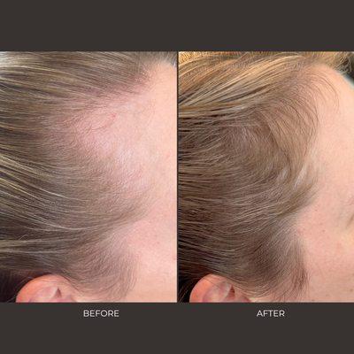 before and after
TED Treatment + Exosomes
Postpartum Hair Loss