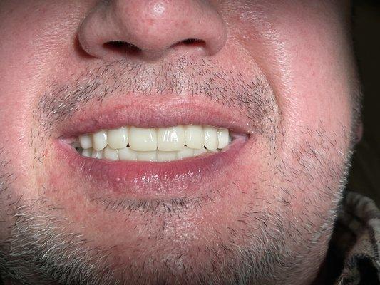 New printed full arch teeth