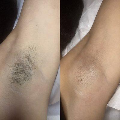 Under arm wax before and after