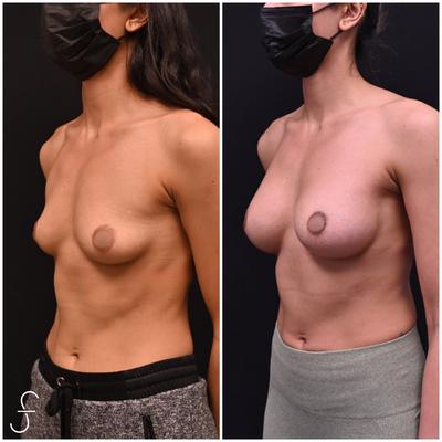 Breast Augmentation