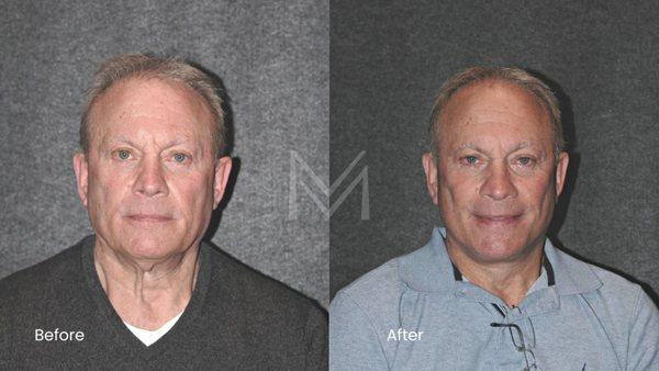 Extended Deep Plane Facelift and Neck Lift