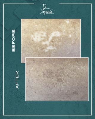 Scar Camouflage
Expert pigment matching creates flawless, natural concealment.