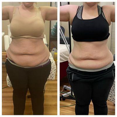 Cool sculpting/Cryotherapy