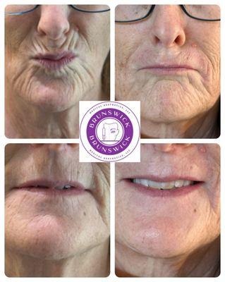 Lip filler used to fill lip lines