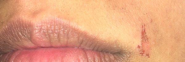 The burn she left on my face.