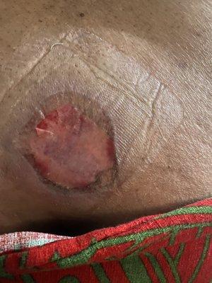 2nd degree burns to lower back.