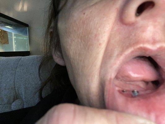 Exposed implant didn't stitch correctly.