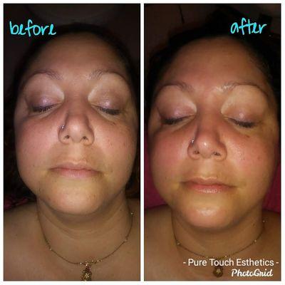 Microdermabrasion with Hydrojelly Mask