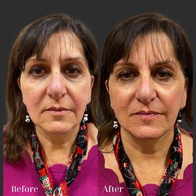 Facial balancing with hyaluronic based dermal fillers