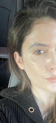 Close up of my skin approx one week after my first Pico treatment.