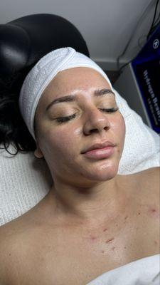 Acne Facial