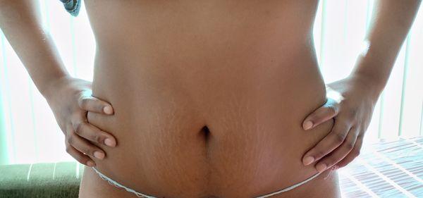 Body Sculpting and Contouring Post 2nd treatment, loss of 4 inches and 6 lbs. Had BBL done wonderful results. Call for post op pics.