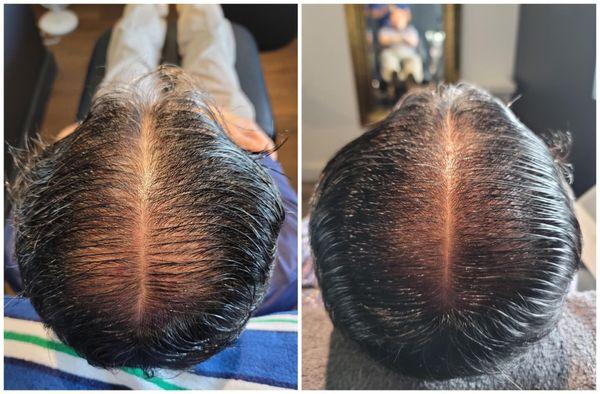 Damo Hair Loss Solution