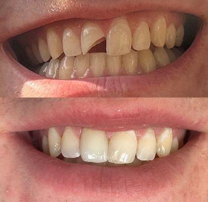 We were able to fix a patient's broken tooth to make it look natural. The patient and I were very happy.