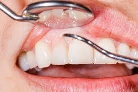 Periodontitis Treatment