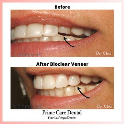 Teeth makeover! Dr. Choi is a certified Bioclear dentist. Prime Care Dental Your Las Vegas Dentist