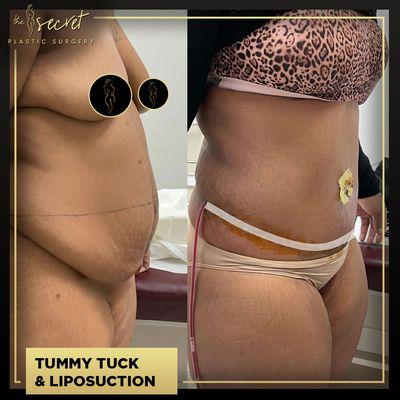 Tummy Tuck Miami - The Secret Plastic Surgery