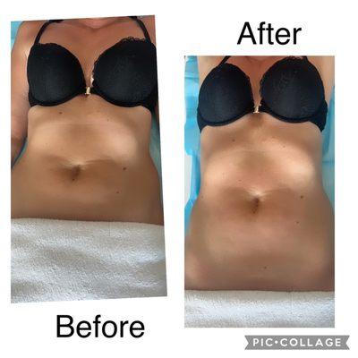 Body contouring