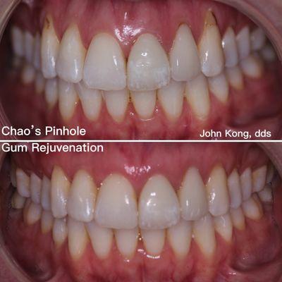 Chao's Pinhole Gum Rejuvenation technique