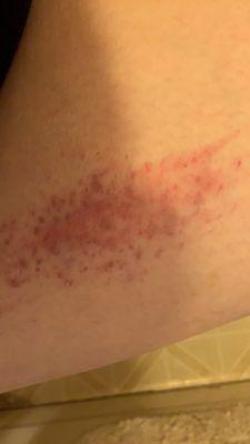 Bruising from assault done by Dr Sheris